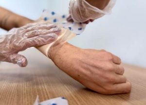 Entre os diversos fatores de lesões na pele, as queimaduras responderam por 2.341 vítimas no Ceará em 2024